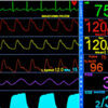 LifeWindow Lite 9x MRI Waveform